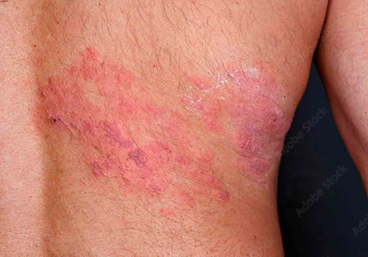 QU ES HERPES Z STER El Diario Bolivia qu-es-herpes-z-ster-el-diario-bolivia