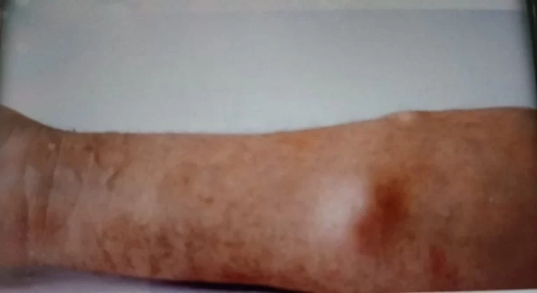 ¿QUÉ ES UN ANGIOLIPOMA?